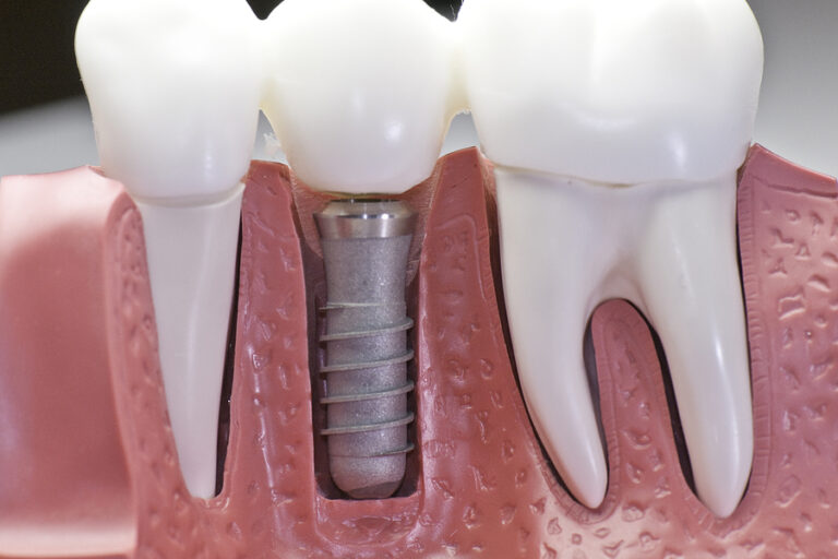 Capped Dental Implant Model