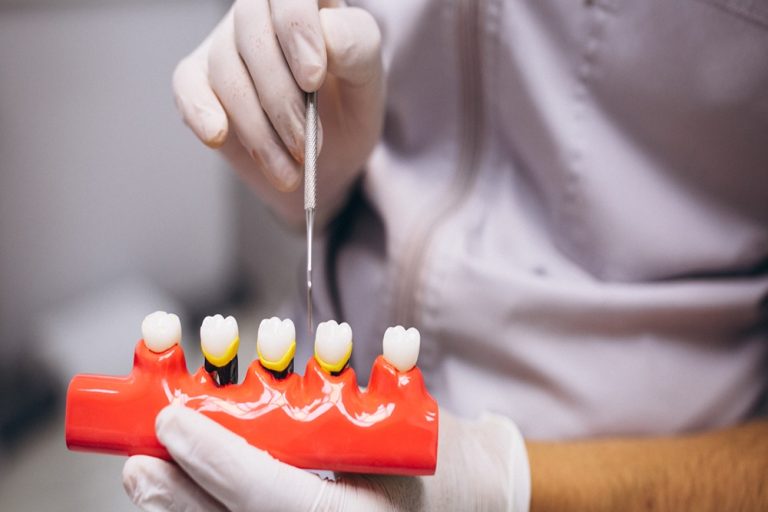 Step-by-Step Guide to Getting Your First Dental Bridge Preparation for a dental bridge on a practice model.