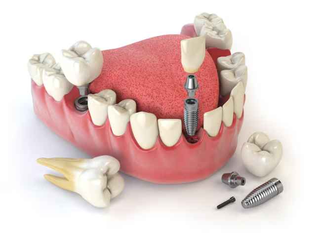 dental implants near me